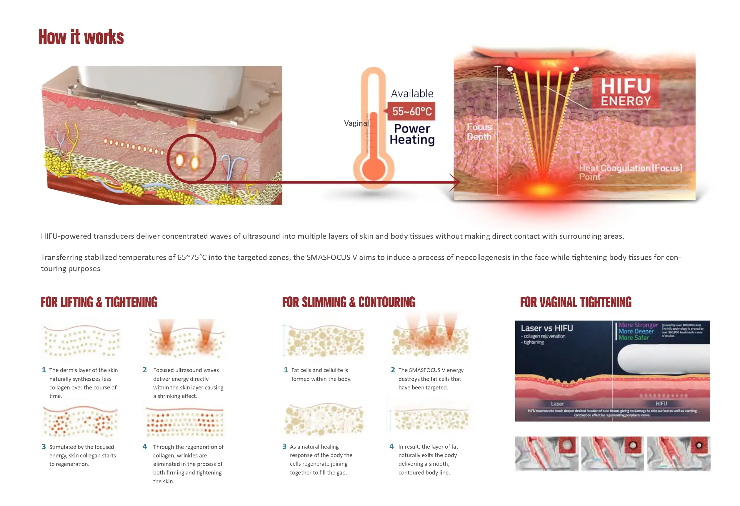 HIFU Machine Manufacturers HIFU Machine Manufacturers